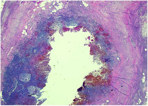 Lower power (20X) acute appendicitis.
