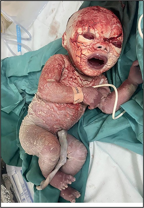 Image showing severe dry scaly patches throughout skin. Note bilateral ectropion.