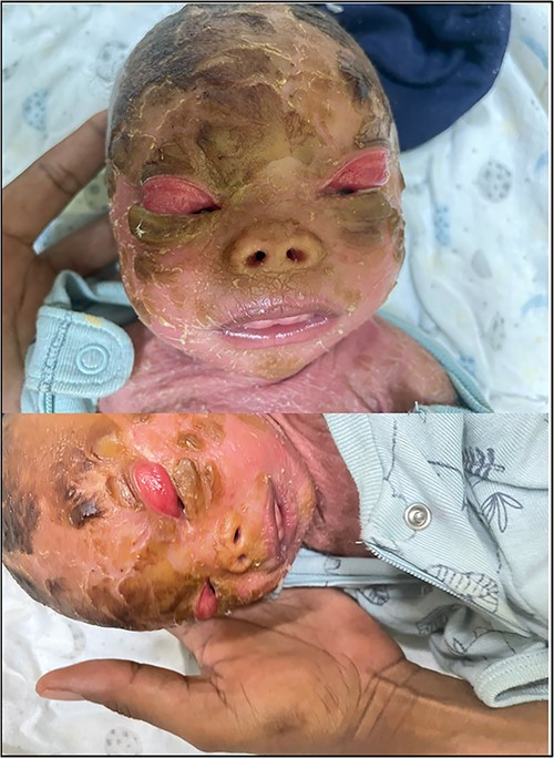 Image showing patient at 17 day of life. Note worsening of ectropion bilaterally.