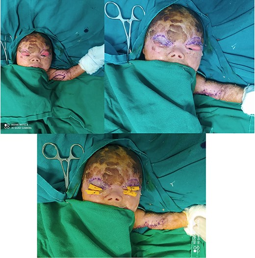 Image showing planned surgical incision site for release of ectropion, followed by harvesting of skin graft, insetting and placement of Frost suture.