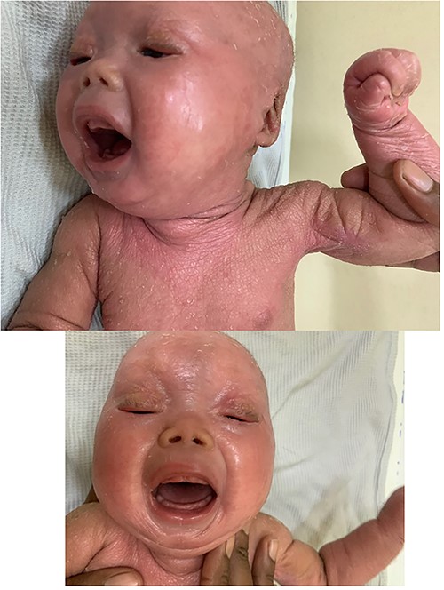 Image showing correction of ectropion at 1-month post-surgery.