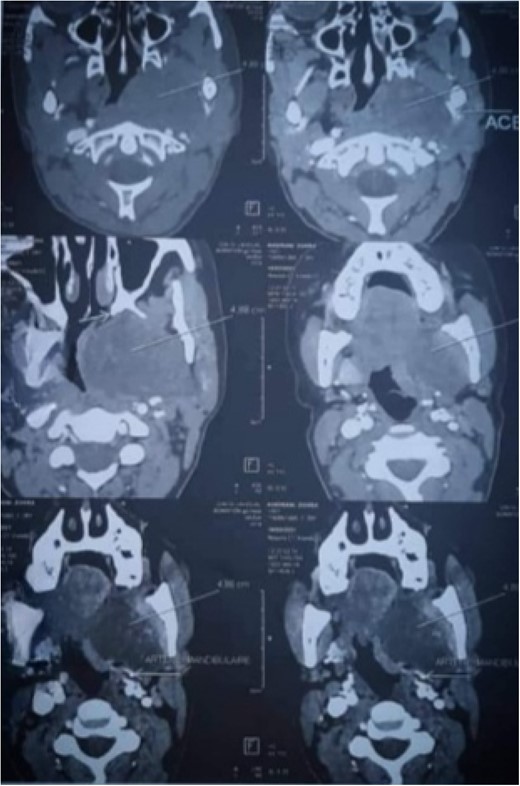 CT cuts of the lesion.