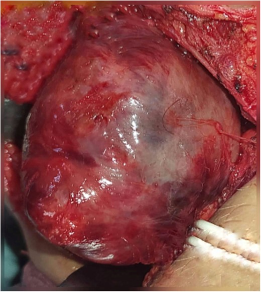 Inra-operative appearance of the lesion.