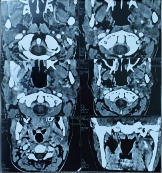 CT cuts after the surgical excision.