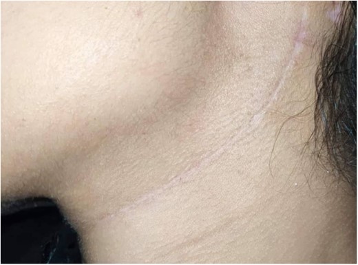 Post-operative appearance of surgical incision.