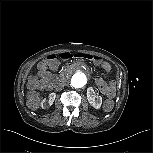 CT angiogram on initial presentation demonstrating an aneurysmal abdominal aorta but no contrast extravasation.