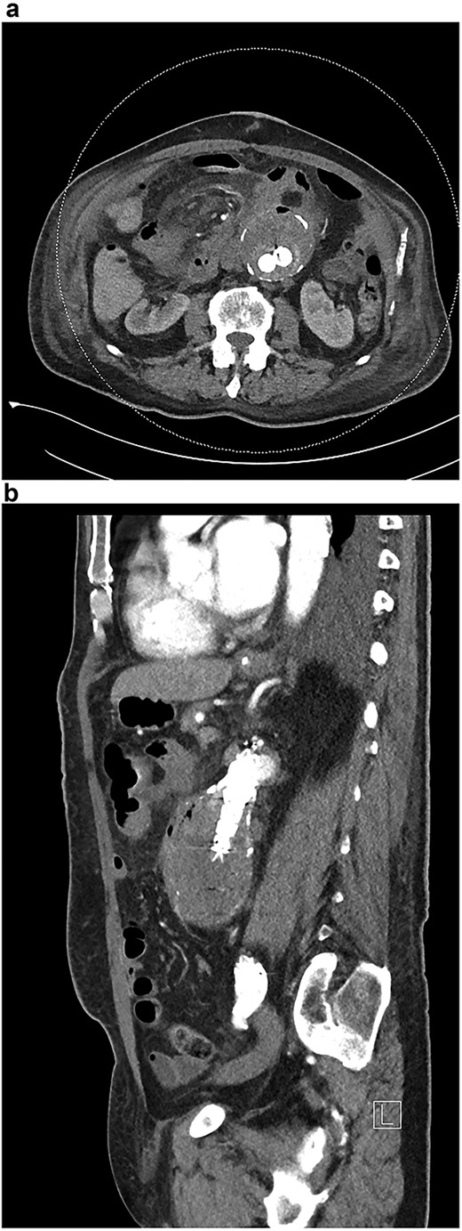 (a and b) CT angiogram after EVAR demonstrating endoleak.