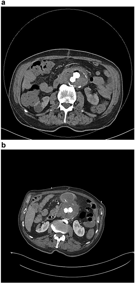 (a) CT angiogram demonstrating new gas in the aneurysmal sac 6 weeks post-repair; (b) CT angiogram just prior to the second repair, demonstrating ongoing endoleak and continuity of the duodenum and sac; part of the duodenal clip is visible.