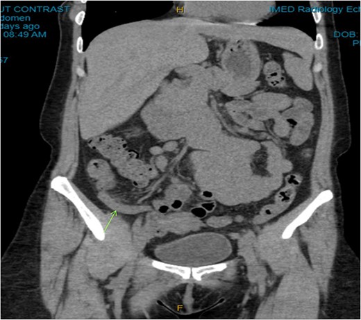 Coronal CT image. Dilated appendix with mild surrounding fat stranding.
