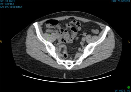 Axial CT image. Retro-cecal inflamed appendix.