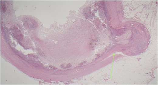 Acutely inflamed appendiceal diverticulum with transmural mixed inflammation extending out into subserosa and serosa.