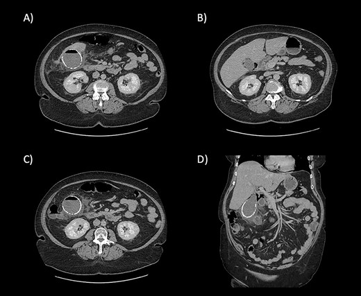 CT scan images demonstrating the calcified wall of the gallbladder consistent with a porcelain gallbladder (A). Pericholecystic fluid and stranding (A and B) demonstrate cholecystitis. The presence of air within the wall and lumen of gallbladder is consistent with emphysematous cholecystitis (C). Air is also seen tracking along the hepatic hilum (D).