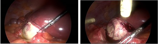 Intraoperative images demonstrating an inflamed porcelain gallbladder.