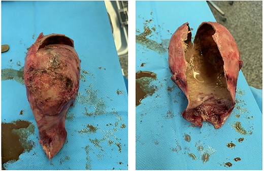 Surgical specimen demonstrating the calcified brittle wall of the porcelain gallbladder.