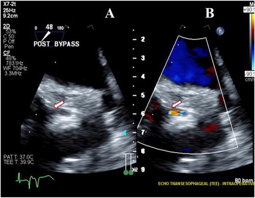 Transesophageal image following re-operative AVR showing severe stenosis (arrow) at the origin of the left main coronary artery (A) with turbulent flow (arrow) on color Doppler imaging (B).