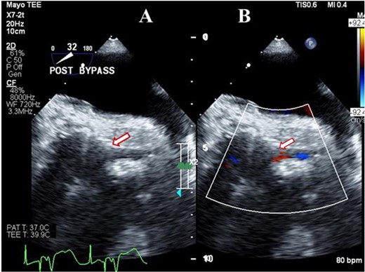 Transesophageal image following Bentall operation showing the widely patent (arrow) left main coronary artery (A) with Laminar flow (arrow) on color Doppler imaging (B).
