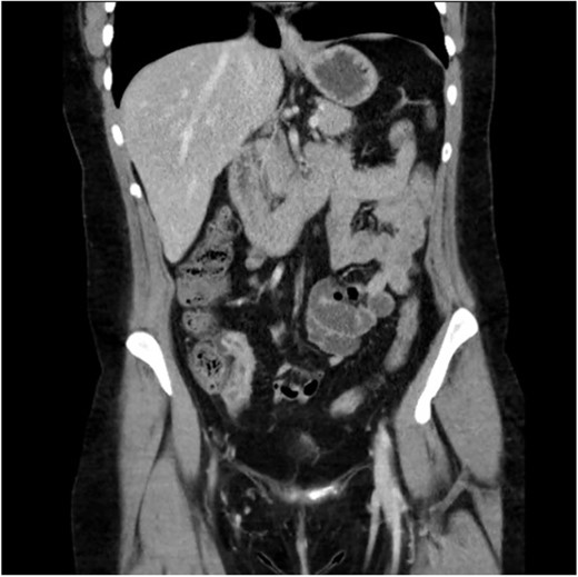 Computed tomography scan (portal venous phase post intravenous contrast) showing a short segment of thickened, enhancing terminal ileum consistent with terminal ileitis of CD.