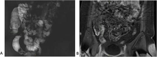 Magnetic resonance enterography demonstrating strictures of the small bowel (A) in a segment of terminal ileitis with acute inflammation (B).