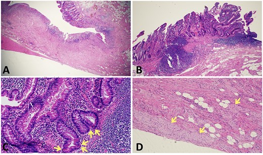 Histopathological findings in CD; (A) H&E section (×20 magnification) showing fissuring ulceration, focal cryptitis, crypt abscess and background smooth muscle hypertrophy; (B) H&E section (×40 magnification) showing submucosal lymphoid aggregates and plasma cells; (C) H&E section (×200 magnification) showing Paneth cell metaplasia (arrows); (D) H&E section (×100 magnification) showing Nerve twig hypertrophy (arrows) at the base of the ulcer.
