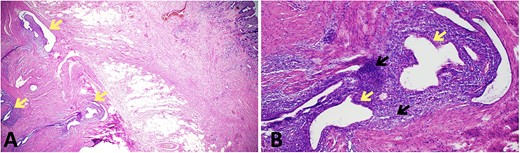 Histopathological findings in endometriosis; (A) H&E section (×20 magnification) showing endometriotic foci (arrows) within the muscularis propria, terminal ileal mucosa is seen in the top right corner; (B) H&E section (×100 magnification) showing a magnified view of an endometriotic focus which comprises of ectopic endometrial glands (yellow arrows) surrounded by ectopic endometrial stroma (black arrows); focal haemosiderin-laden macrophages are also present in the background of ectopic endometrial stroma.