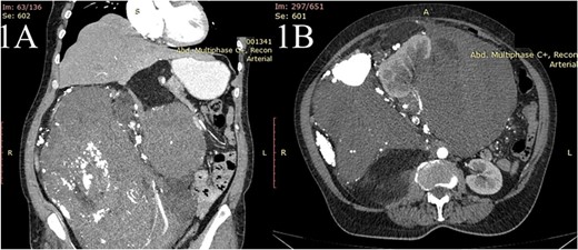 The contrast-enhanced computed tomography (CT) scan shows (A) a huge mass extending from the sub-hepatic region to the pelvis with the cranial displacement of the liver and (B) the same mass causing encasement the right kidney.