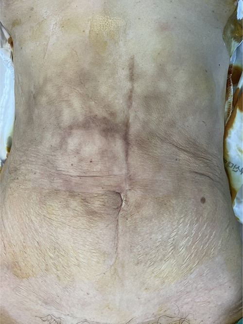 Multiple erythematous brownish skin patches and palpable mass at epigastric area.