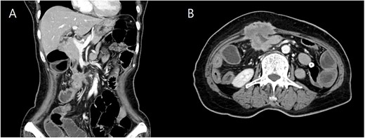 Coronal (A) and axial (B) computed tomography image of abdomen and pelvis showing transverse colon cancer with direct invasion to the rectus muscle and suspicious invasion of superior mesenteric invasion.