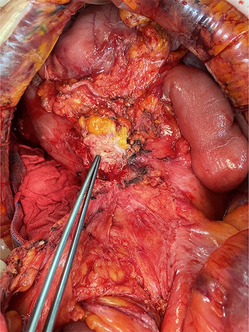 Tumor invaded or was adherent to the duodenum and superior mesenteric vein.