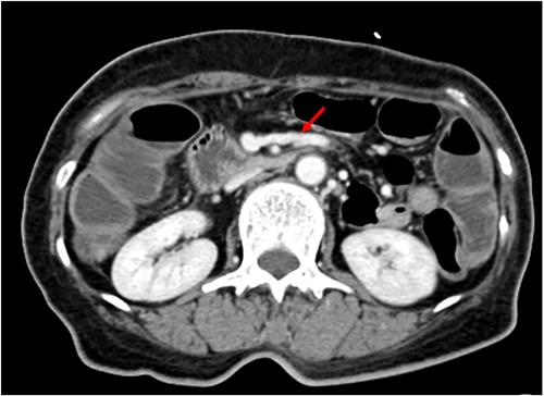 Dilated jejunal first branch of superior mesenteric vein (red arrow).