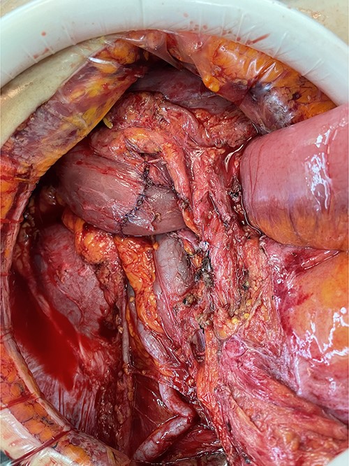 Appearance after en-bloc resection.