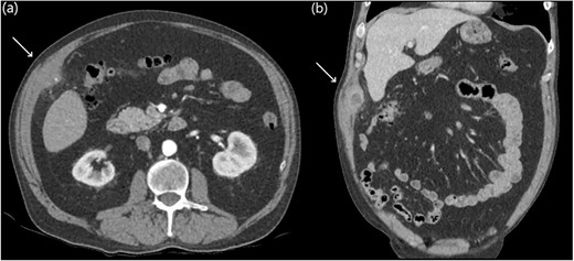 Abdominal CT axial slices (a) demonstrating a tiny focal calcific density in the right upper quadrant, and coronal slices (b) demonstrating a right upper quadrant intramuscular collection.