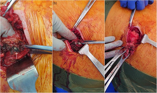 Intra-operative photos demonstrating a small gallstone (a) within the muscular tissue revealing the underlying purulent collection (b) which was drained with complete excision of the capsule (c).