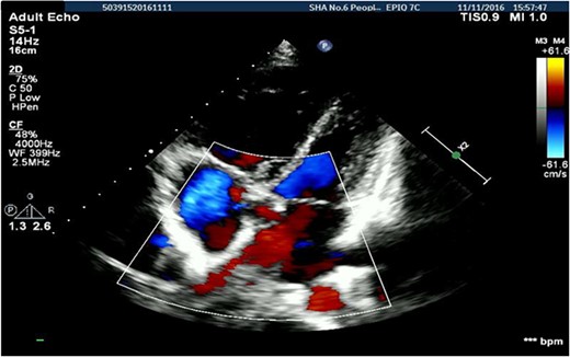 Transthoracic echocardiography suggested secondary atrial septal defect.