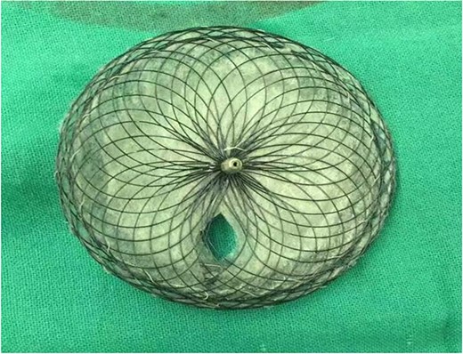 Occlusion of the occluder in advance reserved hole 5 mm.