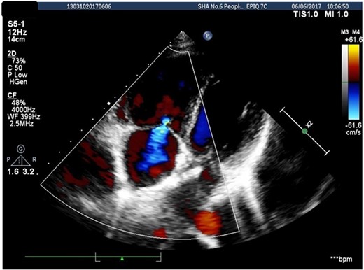 Re-plugged the 5-mm reserved hole.