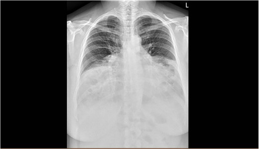 Posterior/anterior chest X-ray showing the reduced size of both lung fields and presence of abdominal contents in the chest cavity bilaterally.