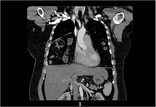 Arterial contrast CT of the chest. Coronal slice transecting the midpoint of the chest cavity showing herniation of large bowel, small bowel and omentum into the chest cavity.