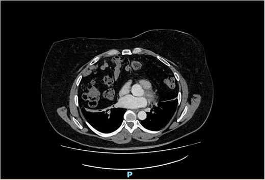 Arterial contrast CT of the chest. Axial slice at the T4/5 level showing herniation of large bowel, small bowel and omentum into the chest cavity. The defect in the anterior diaphragm measures 88.2 mm × 48.2 mm. Of note is the significant reduction in the size of the lung fields.