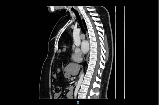 Arterial contrast CT of the chest. Sagittal slice in the midline of the body. The diaphragmatic defect is clearly seen anteriorly, and the abdominal contents are seen extending to the superior mediastinum.
