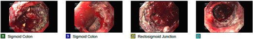 Flexible sigmoidoscopy 72 months following stent placement.