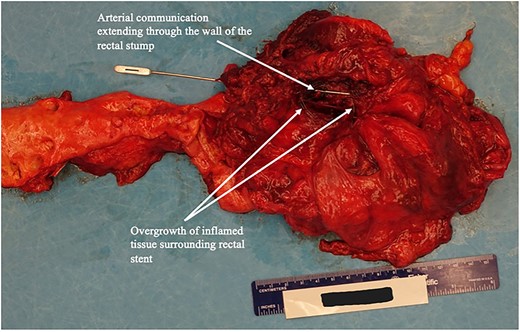 Autopsy image rectal stump and of arterio-rectal communication with left EIA.