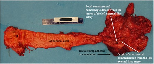Autopsy image of abdominal aorta including site of arterio-rectal communication with left EIA.