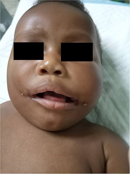 Preoperative picture of the patient with bilateral commissural cleft.