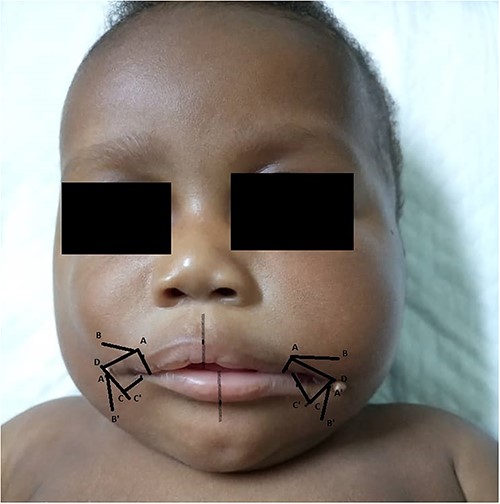 Graphic design of the commissural mucocutaneous flaps.