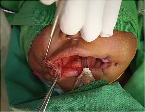 Mucocutaneous flap raised keeping its base in the buccal mucosa.