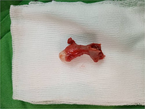 Accessory maxilla removed from the left site with a presence of a distal lesion.