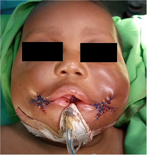 Z-plasty of both commissural cleft.