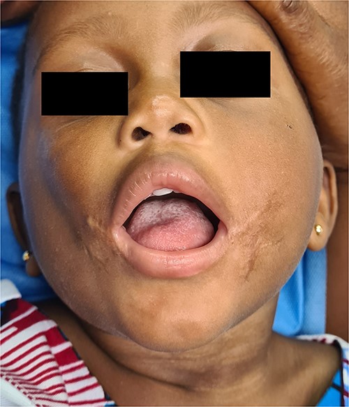 Facial appearance of the patient’s face 1 year after surgery.