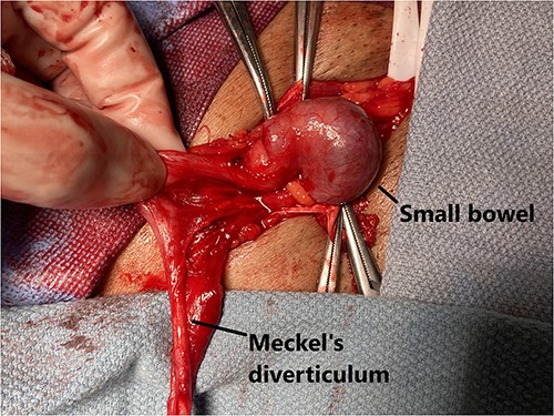 Meckel’s diverticulum identified after opening of the hernia sac.