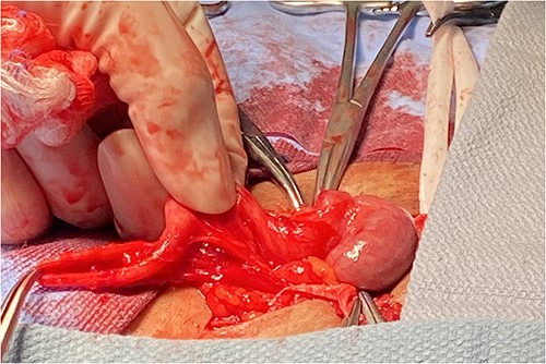 Meckel’s diverticulum attached to small bowel.